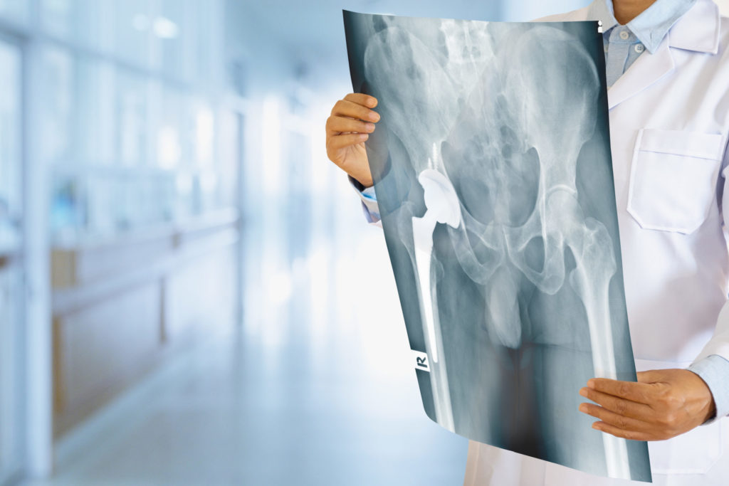 Total Hip Replacement - What You Need to Know