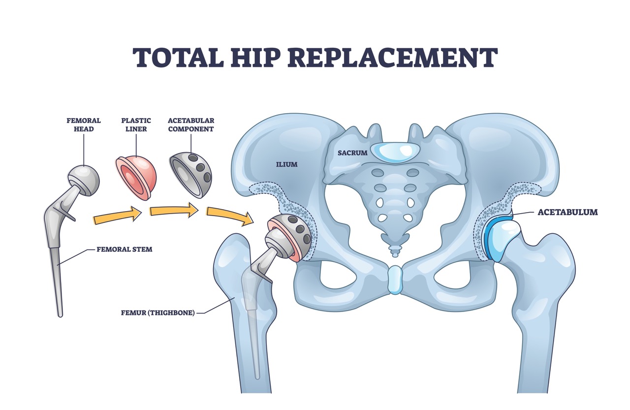 An anatomical drawing of the components of a total hip replacement that make it complete.