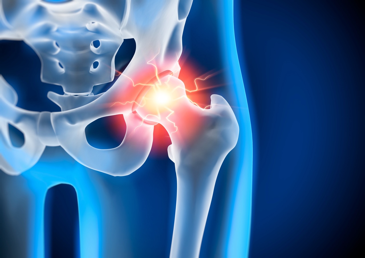 A medical illustration of a painful hip joint.