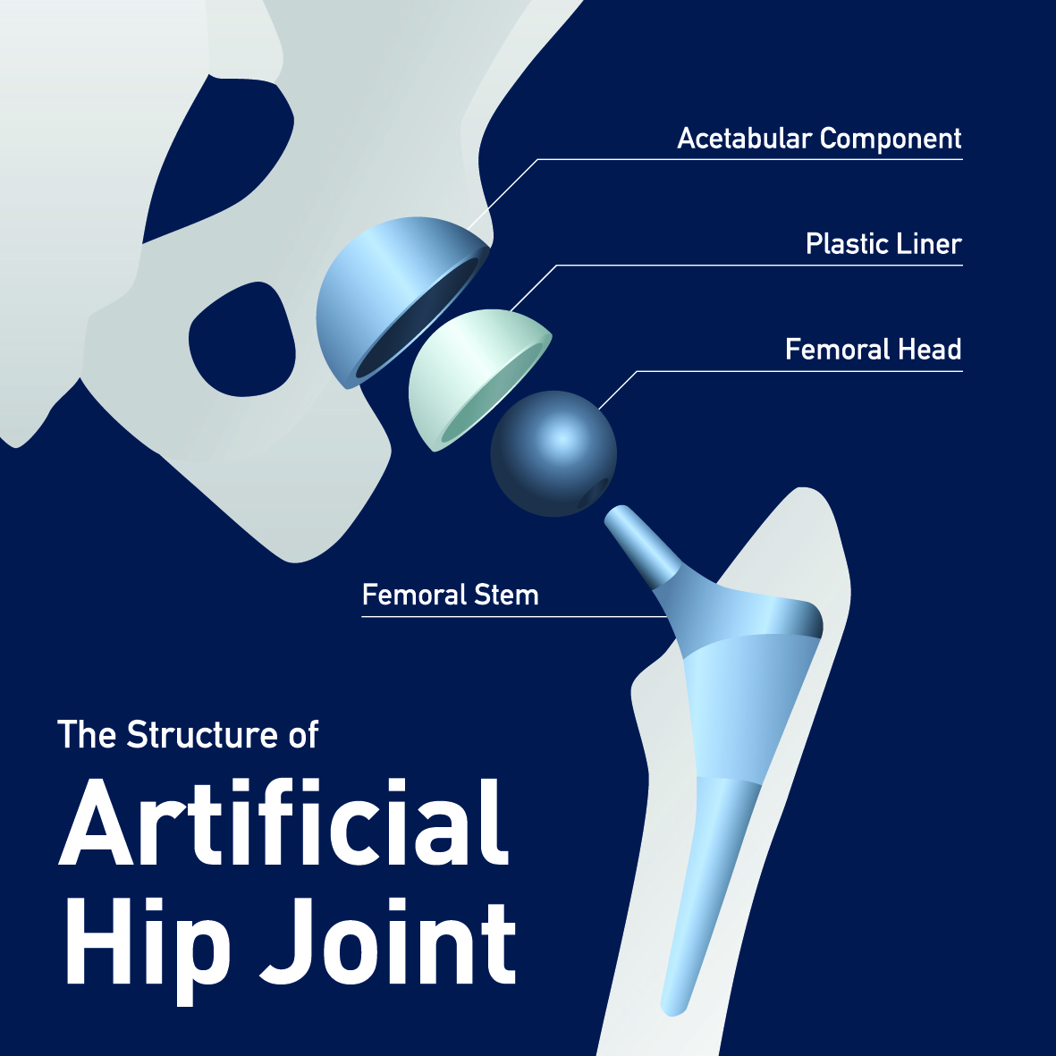 A diagram detailing the structures involved in a total hip replacement. 