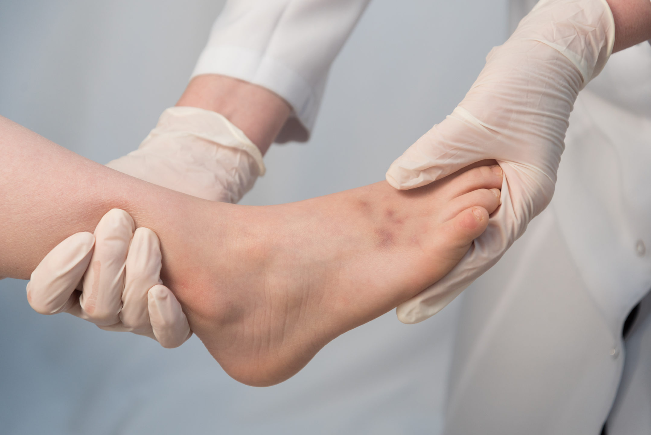 A doctor wearing gloves holds a patient’s foot and ankle. 