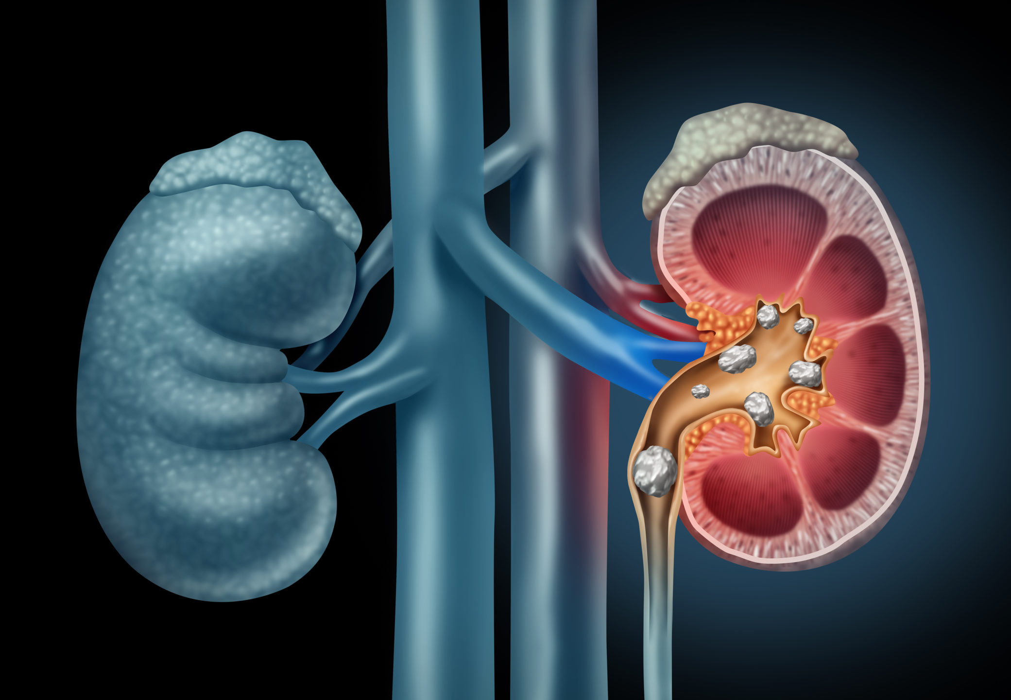 A diagram of human kidneys with kidney stones. 