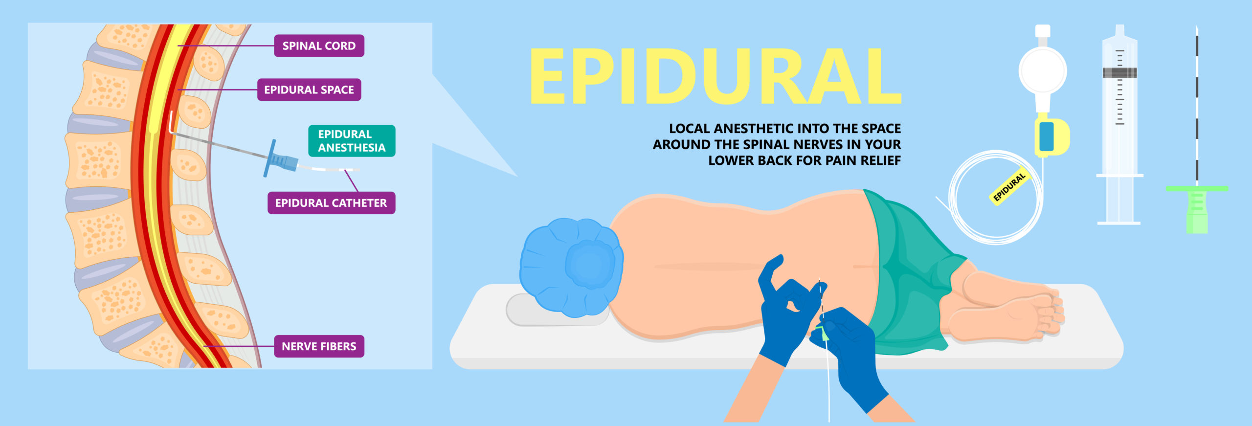 : Illustrated diagram explaining epidural steroid injection in the lumbar spine.