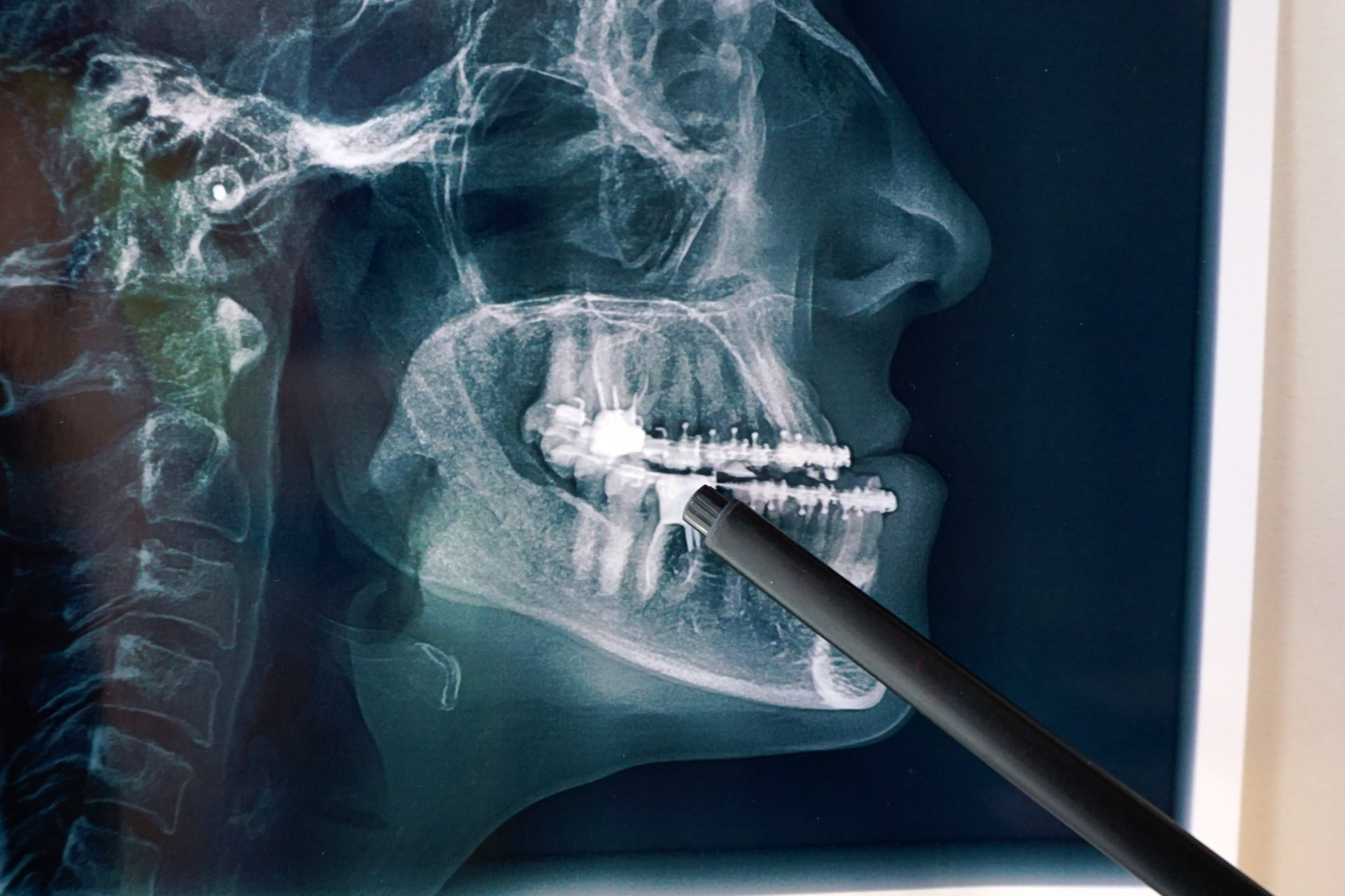 Digital image of a human jaw during a consultation for corrective jaw surgery.