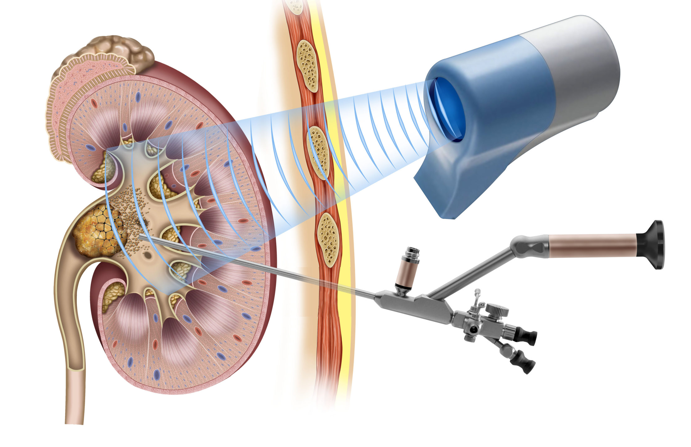  An illustration of a kidney & a kidney stone with kidney stone extracorporeal shockwave therapy sound waves breaking it up. 