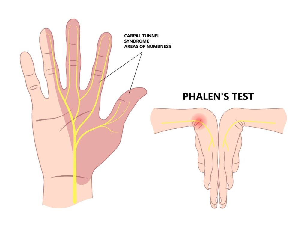 An illustration of hands shows how to do the Phalen’s test for carpal tunnel syndrome. 