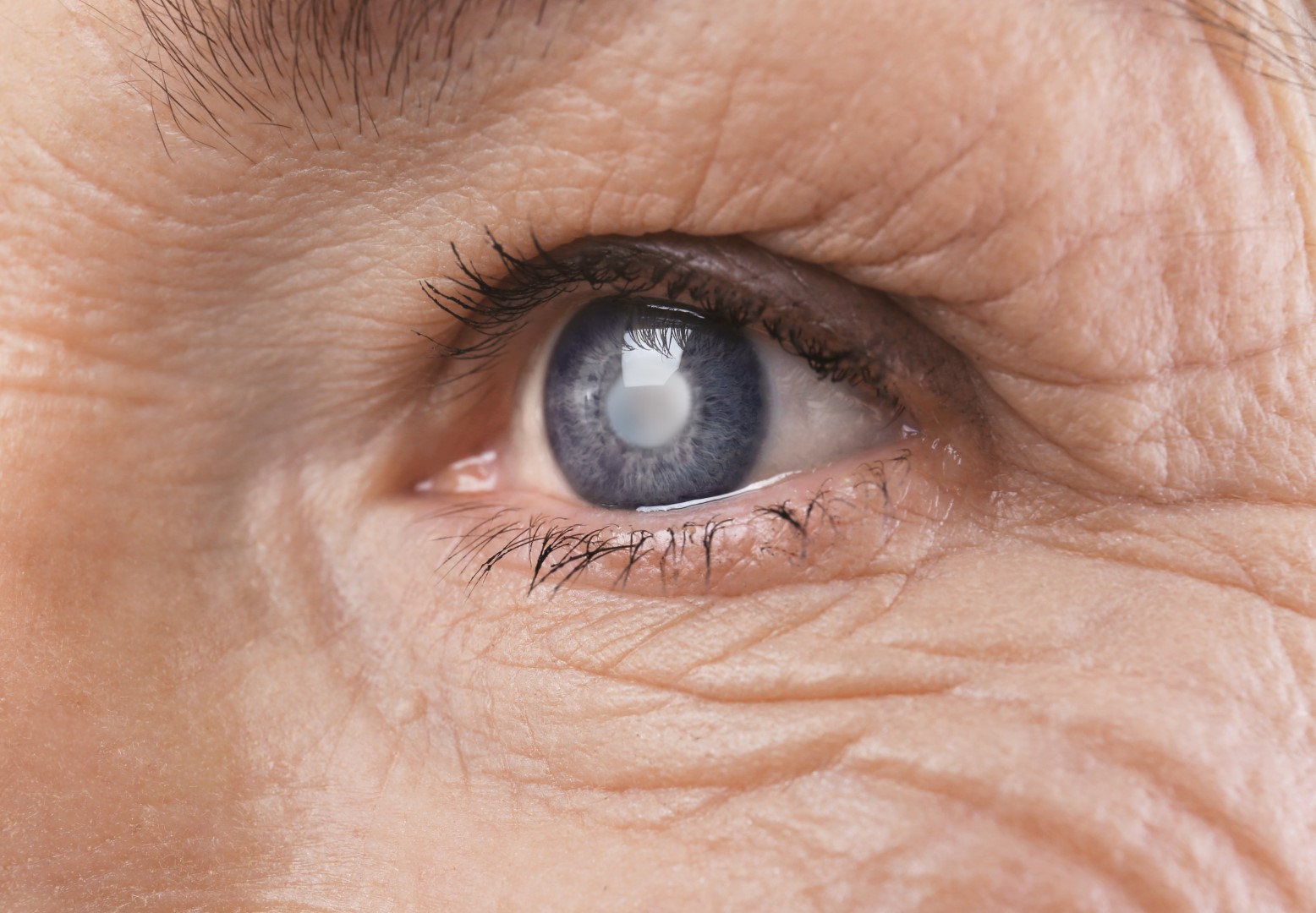 A close-up image shows a cloudy cataract in an older woman’s eye. 