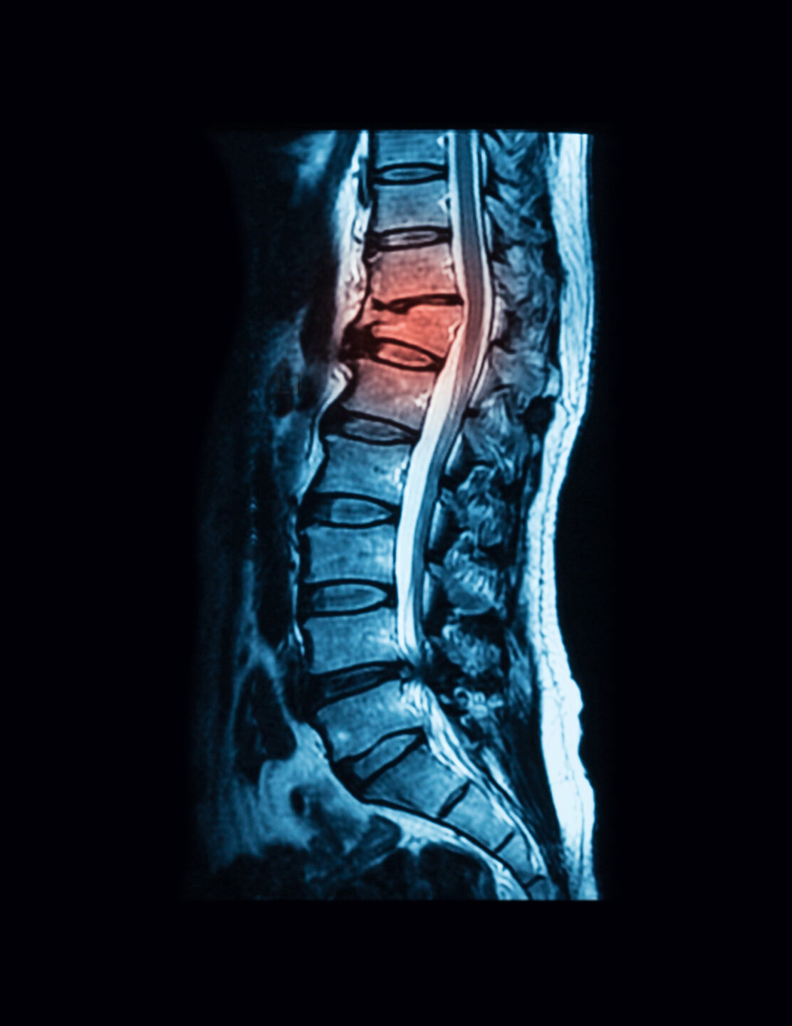 An X-ray of a spine shows a compression fracture highlighted in red.