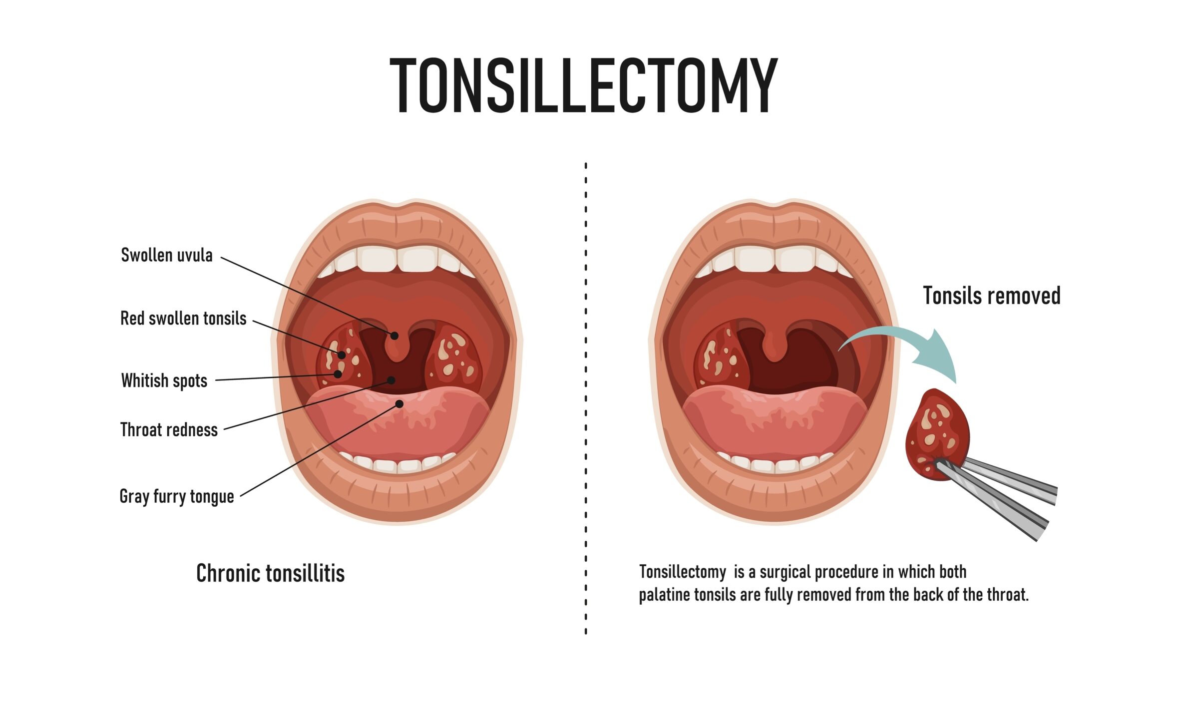 Diagram showing a before and after view of a tonsillectomy, highlighting the removal of swollen, infected tonsils.