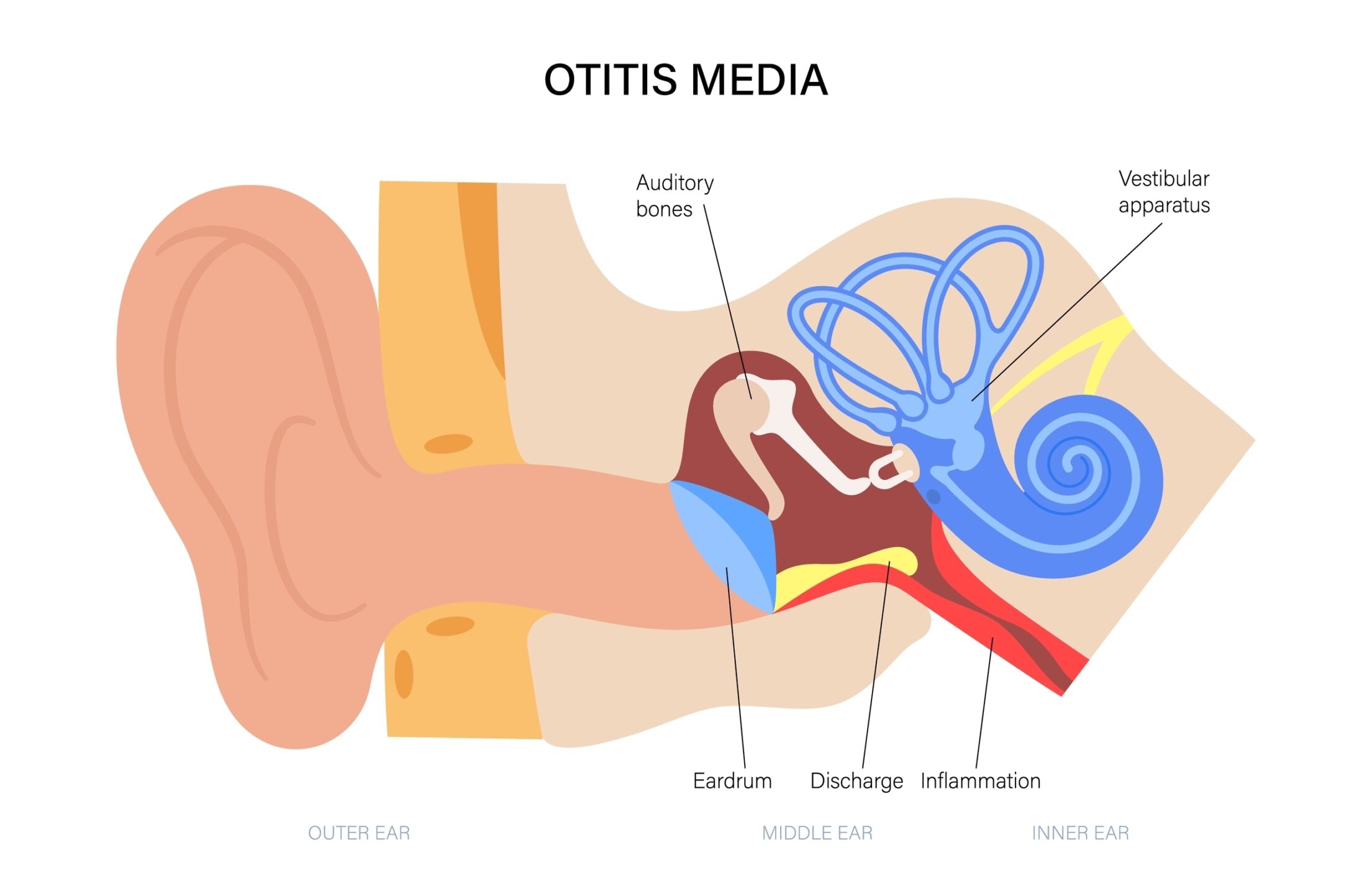 An illustration of the different parts of an ear and where inflammation occurs.