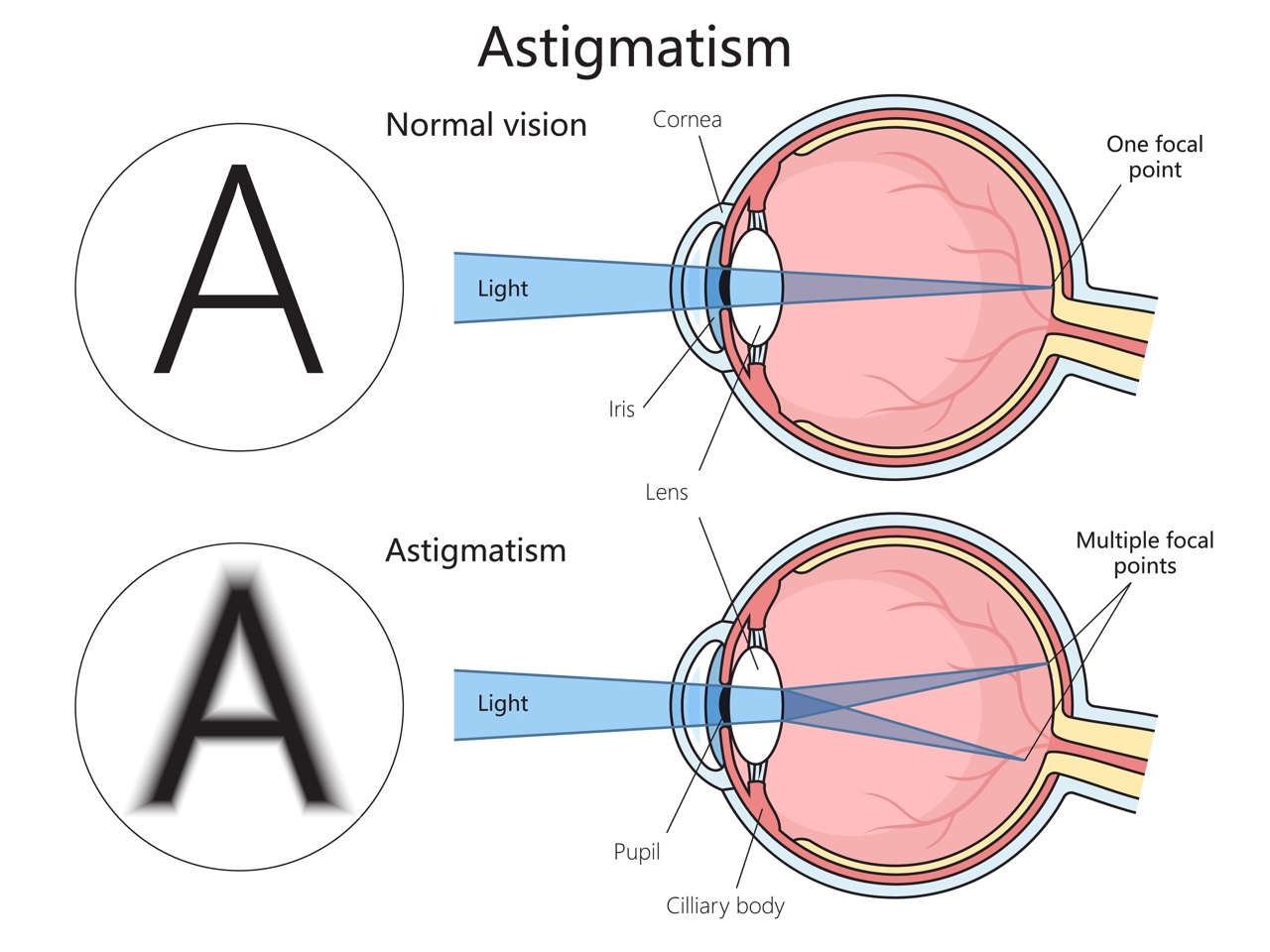 A graphic image compares the anatomy of an eye with normal vision to one with astigmatism. 