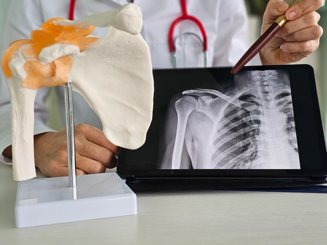 Using a shoulder model and X-ray, a doctor explains what will happen during surgery.