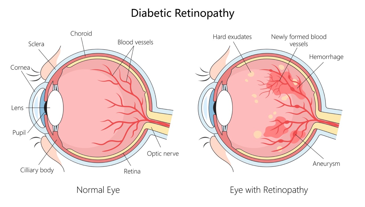 An illustration of an eye's interior shows the damaged blood vessels caused by diabetic retinopathy.